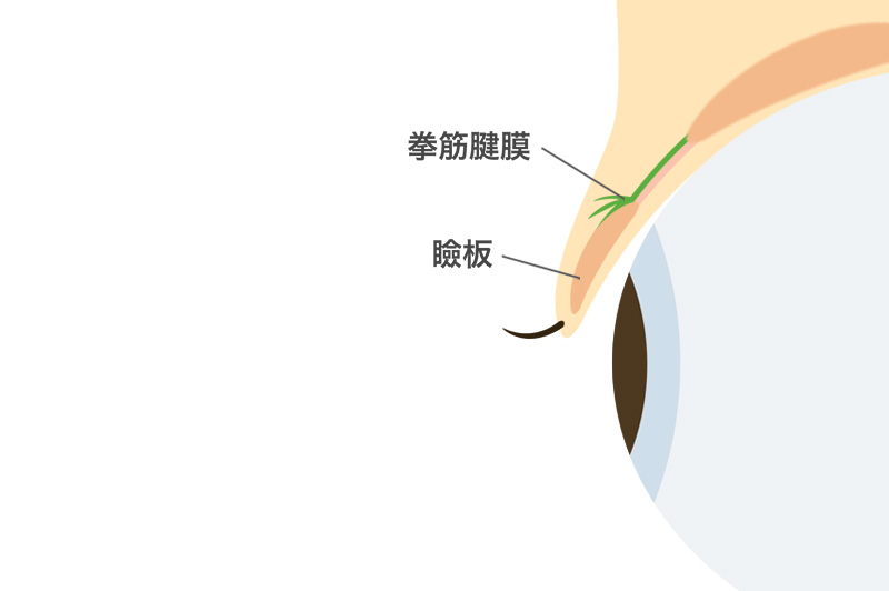 二重埋没法　手術方法01